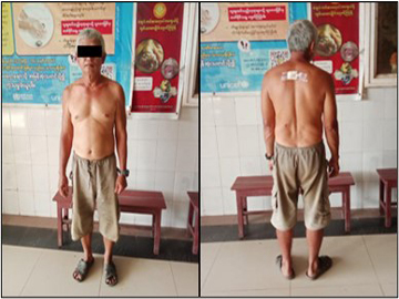 ကရင်ပြည်နယ်၊ ကော့ကရိတ်မြို့နယ်၌ လက်နက်ကိုင်အကြမ်းဖက်သမားများက ရပ်ကွက်အတွင်း လက်နက်ကြီးများဖြင့် ပစ်ခတ်တိုက်ခိုက်ခဲ့မှုကြောင့် အပြစ်မဲ့ အရပ်သားပြည်သူ တစ်ဦး ထိခိုက်ဒဏ်ရာရရှိ