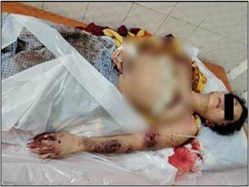 ပဲခူးတိုင်းဒေသကြီး၊ အုတ်ဖိုမြို့နယ်၌ ဗုံးသီးဟောင်း တစ်လုံး ပေါက်ကွဲခဲ့မှုကြောင့် အပြစ်မဲ့ အရပ်သားပြည်သူ တစ်ဦး ထိခိုက်ဒဏ်ရာရရှိ
